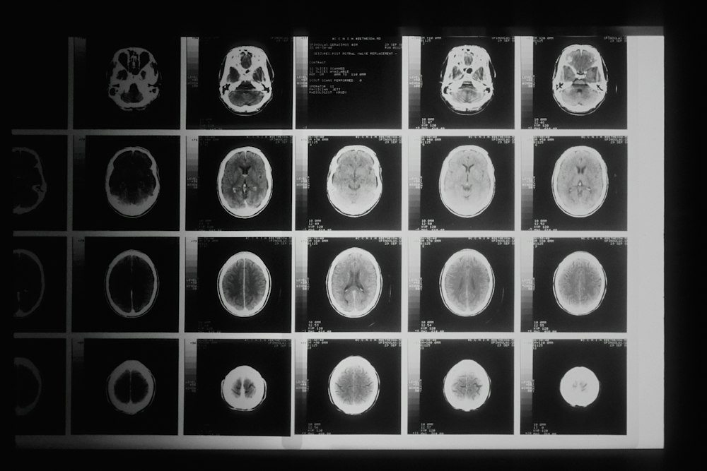 Brain MRI scans used to diagnose a traumatic brain injury